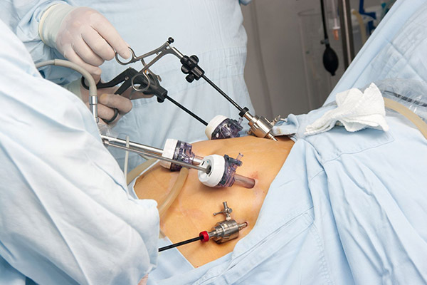 What is Bariatric Surgery?