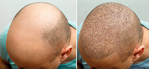 What is a Hair Transplant?